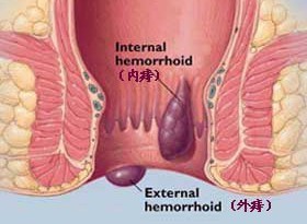 引起内痔反复发作的原因